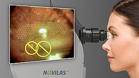 Navigated non-contact panretinal photocoagulation with Navilas 577s