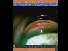 MLT treatment with Navilas 577s