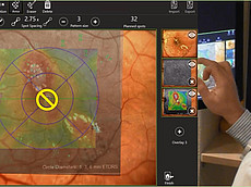 Focal OCT-guided treatment with the Naviilas navigated retina laser