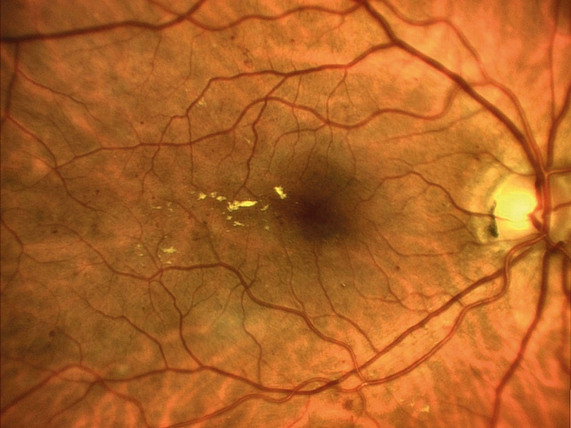 Прижигание сетчатки. Диабетическая ретинопатия биомикроскопия. Телеангиоэктазии макулы.