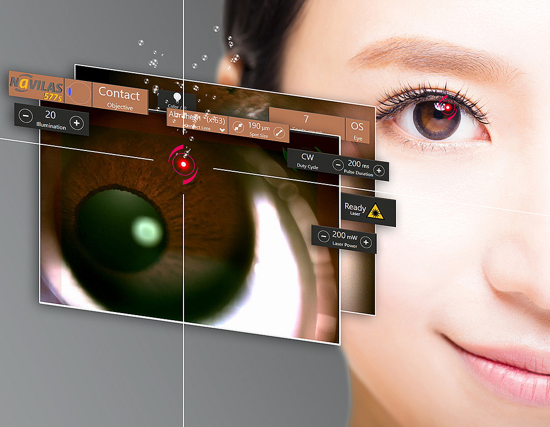 Iridotomy treatment of narrow-angle glaucoma with the Navilas 577s retina laser
