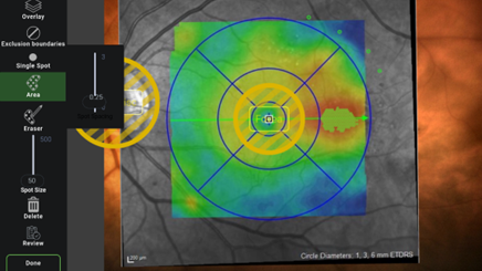 How to use Navigate App 2.0 for the best approach to retinal laser