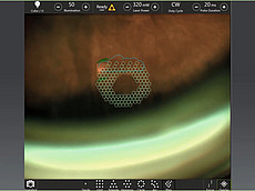 Retinopexy treatment with the Naviilas navigated retina laser