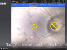 Intuitive Microsecond Pulsing Treatment - Software 3.4