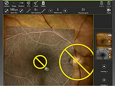 Microsecond pulsing treatment with the Naviilas navigated retina laser