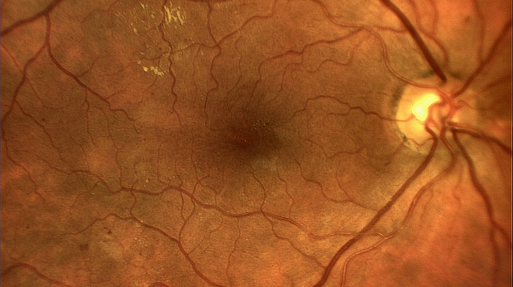 Ангиопатия сосудов сетчатки что это. Непролиферативная диабетическая ретинопатия. Сетчатка непролиферативная ретинопатия. Ретинопатия непролиферативная стадия. Пролиферативная диабетическая ретинопатия глазное дно.