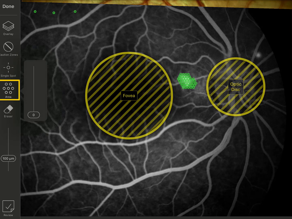 Navigate App - teaching retinal laser