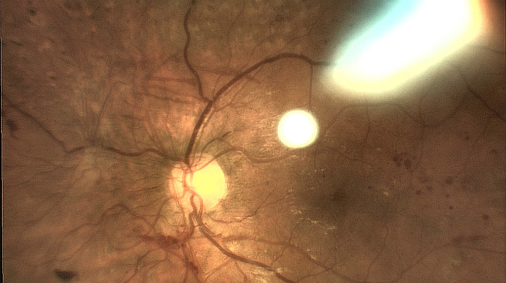 Proliferative Retinopathie