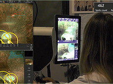 Speed PRP treatment with the Naviilas navigated retina laser